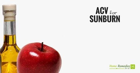 apple cider vinegar for sunburn