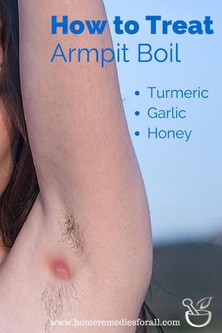 Home Remedies & Natural Treatment for Boils Under Armpit