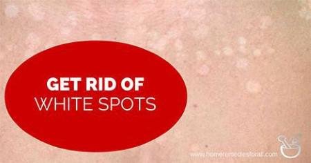 How To Get Rid Of White Spots On Legs 113