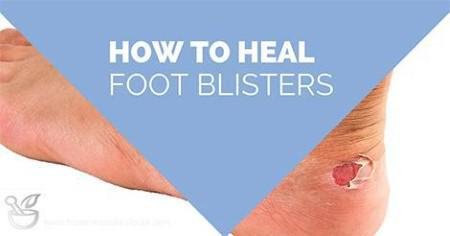 Foot blister