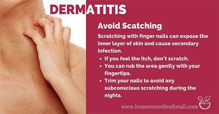 Home Remedies for Dermatitis