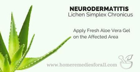 Aloe vera for Neurodermatitis