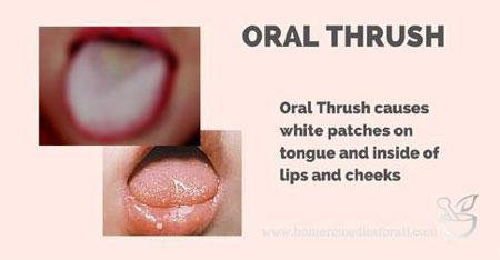 How do I get rid of a thrush infection in the mouth?