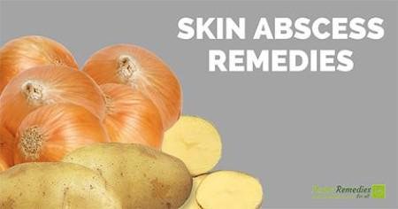 Onions and  Potatoes for skin abscess