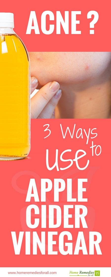 apple cider vinegar for acne infographic