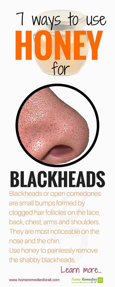 honey for blackheads infographic