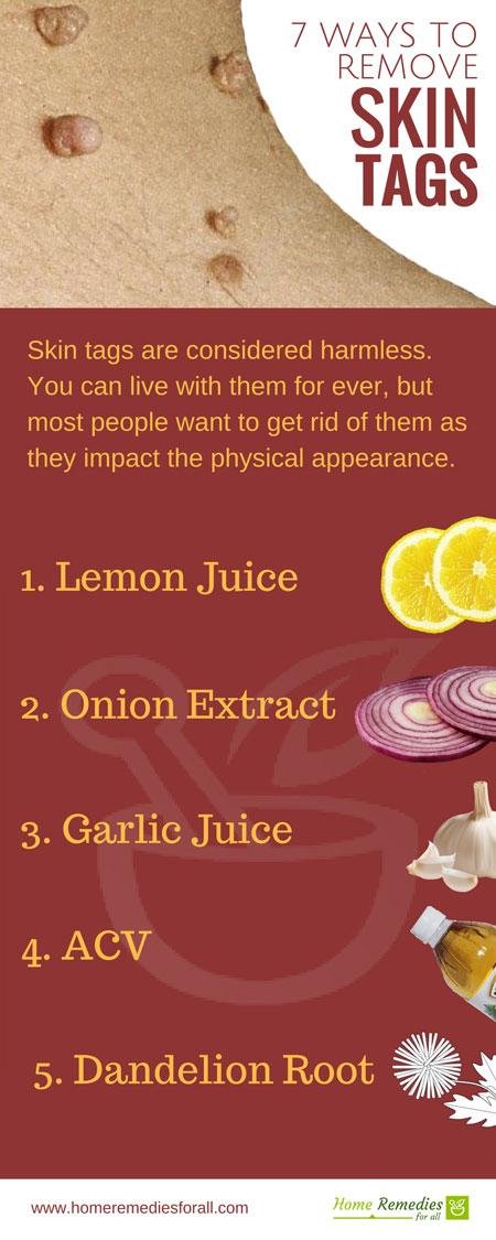 skin tag removal infographic