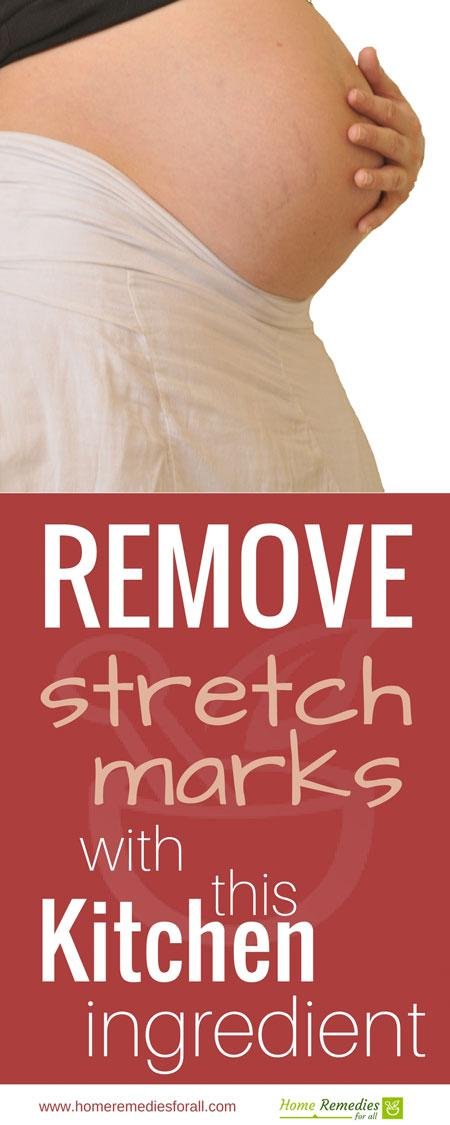 sugar for stretch marks infographic