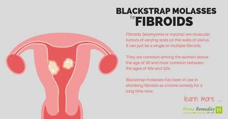 blackstrap molasses for fibroids