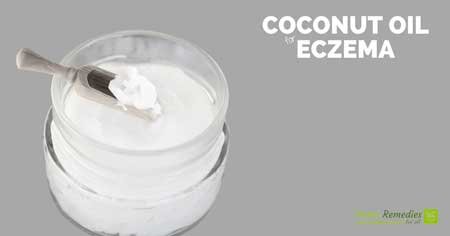 coconut oil for eczema