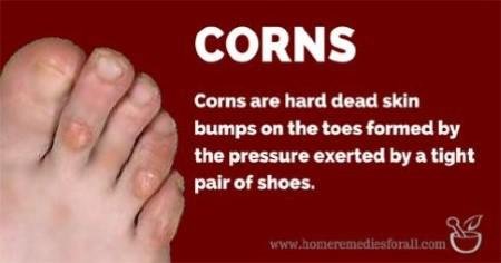 Corns on toes