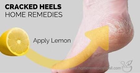 cracked heels home remedies