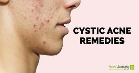 A face with cystic acne