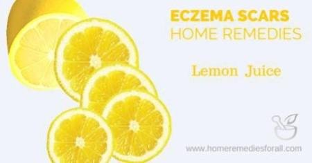 5 Remedies to Get Rid of Eczema Scars