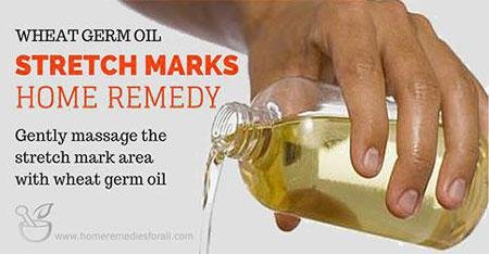 Home Remedies for Stretch Marks