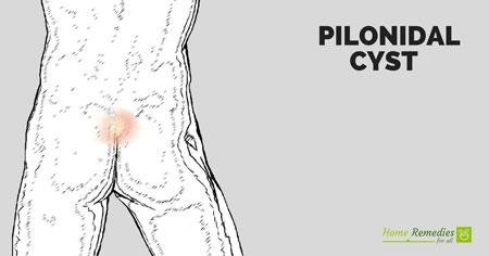pilonidal cyst remedies