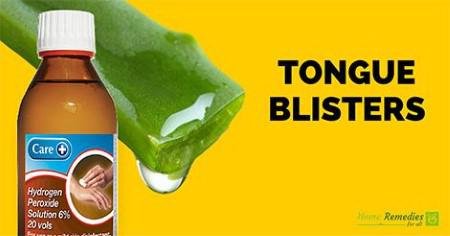 Aloe Vera H2O2 for blisters on tongue